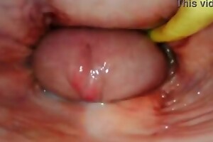 Gaping